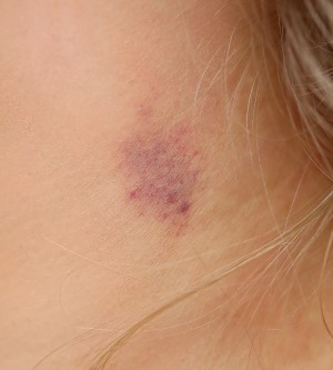 Looks breast red hickey like spot on Small red