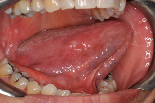 white spots at the back of mouth and tongue