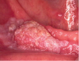 Cancerous lumps on tongue