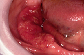 Cancerous lumps under tongue